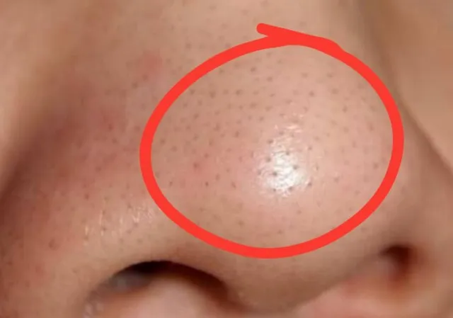 people are just realizing that tiny spots on their nose are actually not bl 11893