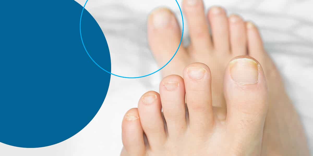 How to Prevent and Treat Toenail Fungus - FASA