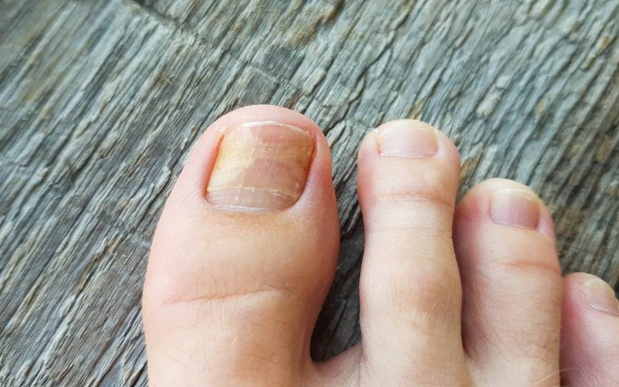 What Are The Best Toenail Fungus Treatments? - Scripps Health